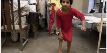 Ein Mädchen mit schwerer Gehbehinderung bei einem von Rotary und dem indischen Gesundheitsministerium organisierten Polio Camp, in dem Post-Polio-Patienten untersucht werden; Rotary International