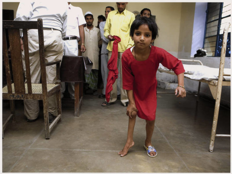 Ein Mädchen mit schwerer Gehbehinderung bei einem von Rotary und dem indischen Gesundheitsministerium organisierten Polio Camp, in dem Post-Polio-Patienten untersucht werden; Rotary International