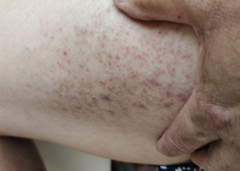 Haben Sie Petechien? Was sind sie und wie erkennt man sie?