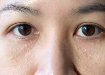 Keratosis Pilaris im Gesicht: Top 5 Tipps gegen Reibeisenhaut 