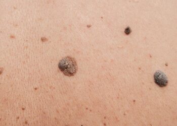 Erhabene Altersflecken entfernen: Darauf solltest du achten